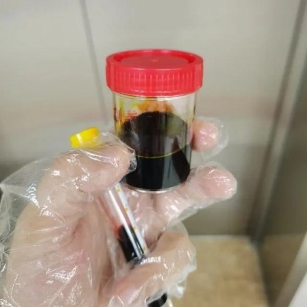 急性肝衰竭！兩兄弟誤吃這種菌 專(zhuān)家提醒