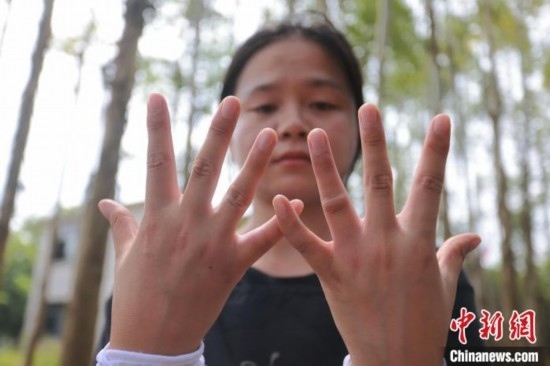 吳素英展示被蜜蜂蜇過的雙手。湯曉逵 攝