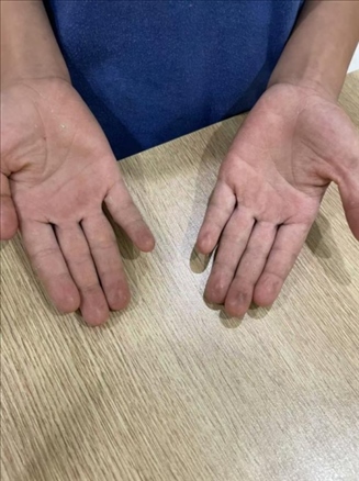 9歲小學(xué)生長(zhǎng)期拍煙卡，手部粗糙長(zhǎng)繭。受訪者供圖