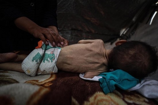 這是5月28日在加沙城西部一處臨時安置點拍攝的一名營養(yǎng)不良的嬰兒。新華社發(fā)（馬哈茂德·扎基攝）